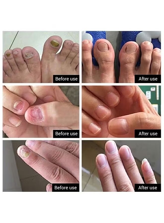 لان بينا مصل إصلاح الأظافر ، إصلاح الأظافر ، إصلاح وتجديد الأظافر التالفة والمكسورة والمتشققة والمتلونة (15 مل) - Image 3