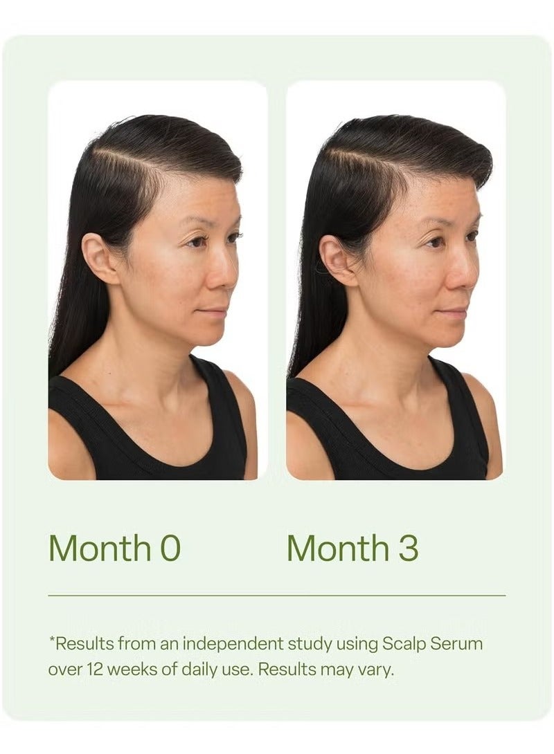 ديفي رقيق الشعر فروة الرأس الجوهر ، 30 مل - بعد التجارب السريرية ، يحتوي على الأحماض الأمينية والكافيين وزيت إكليل الجبل الصيغة الغذائية - تعزيز صحة فروة الرأس والشعر الامتلاء ، والحد من تراكم الدهون والمنتجات - Image 5