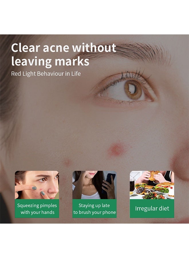 YOUBUY Anti - Acne Cream,Remove Acne and Treats Blackheads Gel ,Remove Acne Pimple and Treats Blackhead with Azelaic Acid Oil, Control Shrink Pores Redness ,Acne Remover Cream,Night Use 20g - Image 5