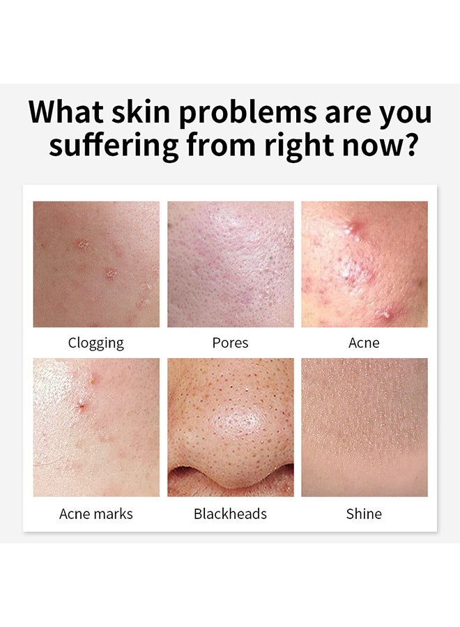 YOUBUY Anti - Acne Cream,Remove Acne and Treats Blackheads Gel ,Remove Acne Pimple and Treats Blackhead with Azelaic Acid Oil, Control Shrink Pores Redness ,Acne Remover Cream,Night Use 20g - Image 3