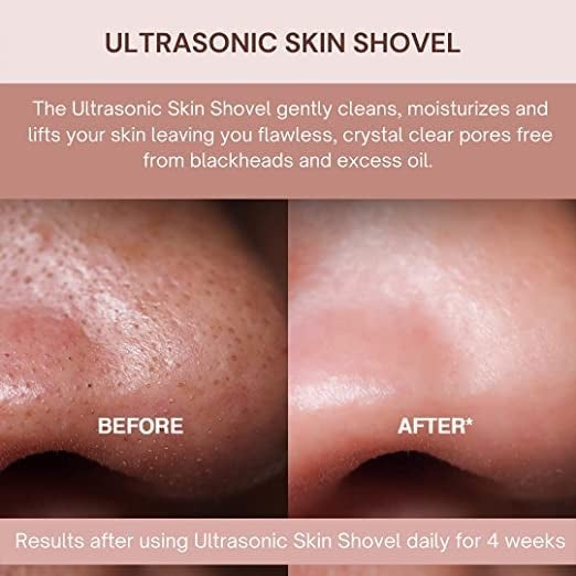 Fiiasa FIIASA Ultrasonic Blackhead Remover Extractor Skin Scrubber Machine for Face Men Women Acne Pore Cleaner Whitehead Extractor Serum Infuser Machine with Microcurrent Facial - Image 4
