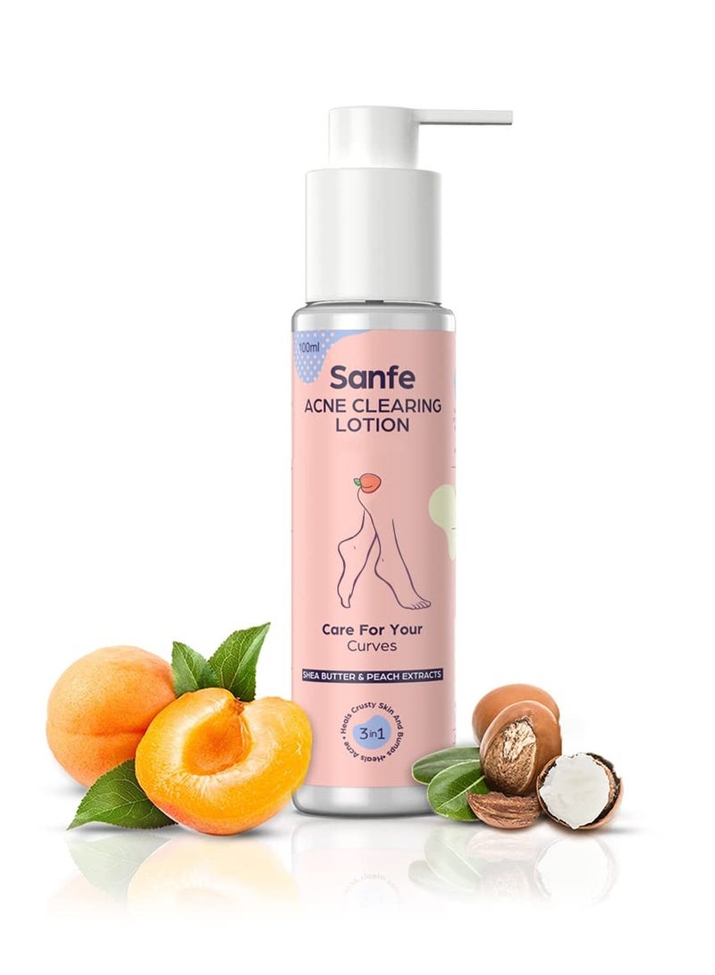 Sanfe Acne Clearing Lotion Ingrowns Dry Crusty Skin 10X Power Shea Butter Exfoliation Lightening 24Hr Moisture 100ml - Image 1