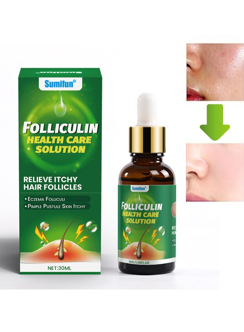 سوميفون محلول فوليكولين للرعاية الصحية، لتخفيف حكة بصيلات الشعر، ومسام الاختراق العميقة، ومنع نمو البكتيريا والعناية اللطيفة بالبشرة، ومناسب للأكزيما وبصيلات الشعر والحطاطات والبثور وحكة الجلد (30 مل) - Image 1