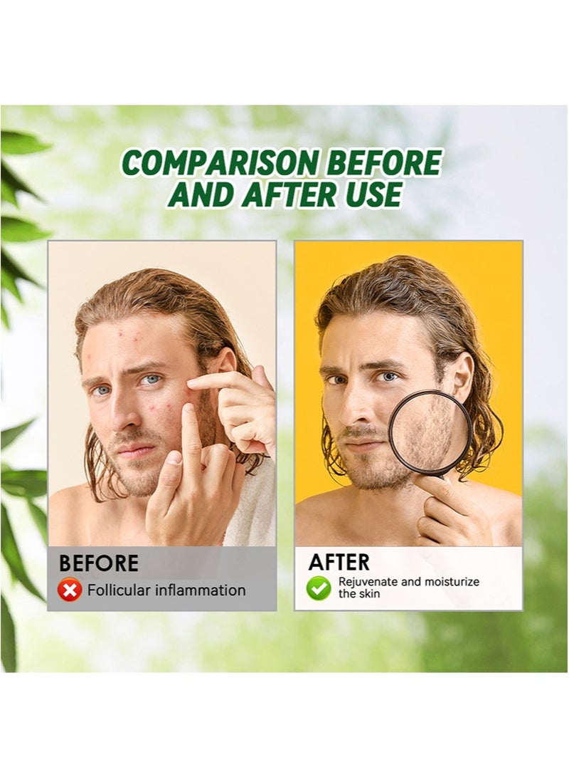 سوميفون محلول فوليكولين للرعاية الصحية، لتخفيف حكة بصيلات الشعر، ومسام الاختراق العميقة، ومنع نمو البكتيريا والعناية اللطيفة بالبشرة، ومناسب للأكزيما وبصيلات الشعر والحطاطات والبثور وحكة الجلد (30 مل) - Image 5