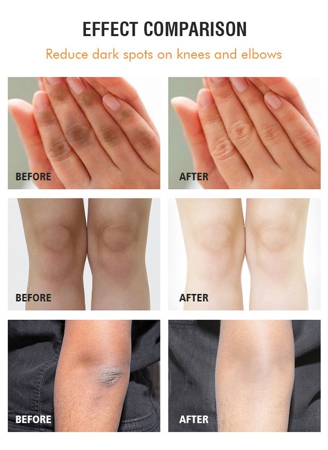 MOOYAM - Dark Knees And Elbows Strong Whitening Cream, Get Rid Of Knuckles Easily In Just 7 Days, Practical Bleaching Body Lotion For Armpits, Neck, Knee, Elbow, Inner Thigh, Intimate Area, 120G - Image 1