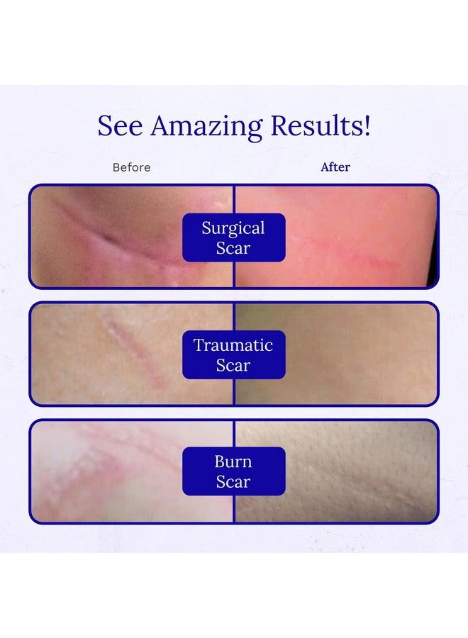 Rejuvaskin Rejuvaskin RejuvaSil Silicone Scar Gel, Scar Treatment for Surgical Scars, Burns, Keloids, Acne Scars on Face & Body, 0.33 ounce - Image 4