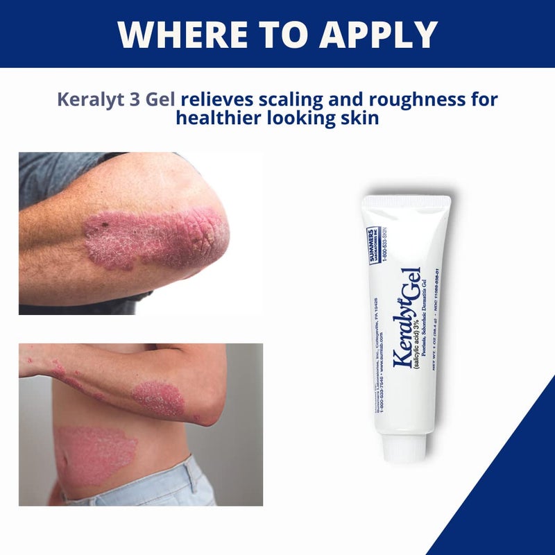 keralyt Keralyt 3% Salicylic Acid Gel - Exfoliating Moisturizing Skin Gel - Promotes Relief from Itchy, Redness, Dryness, Roughness, and Flakey Skin from Psoriasis, Eczema, Acne, Dermatitis  - Image 5