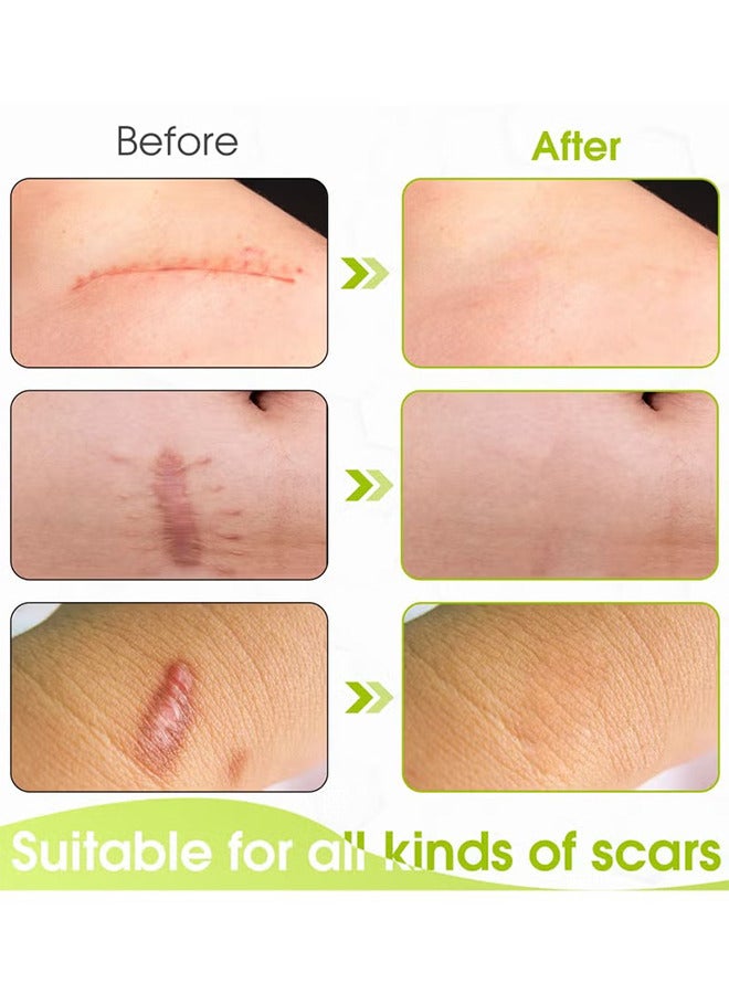 ساوث مون أوراق ندبة السيليكون ، ندوب تتلاشى إزالة ندبة مستحضرات تجميلية فعالة للرقابة القيصرية الندوب والندبات الأخرى التي تركت وراء الهلام لفة غير مؤلمة (4 سم × 1.5 م) - Image 5