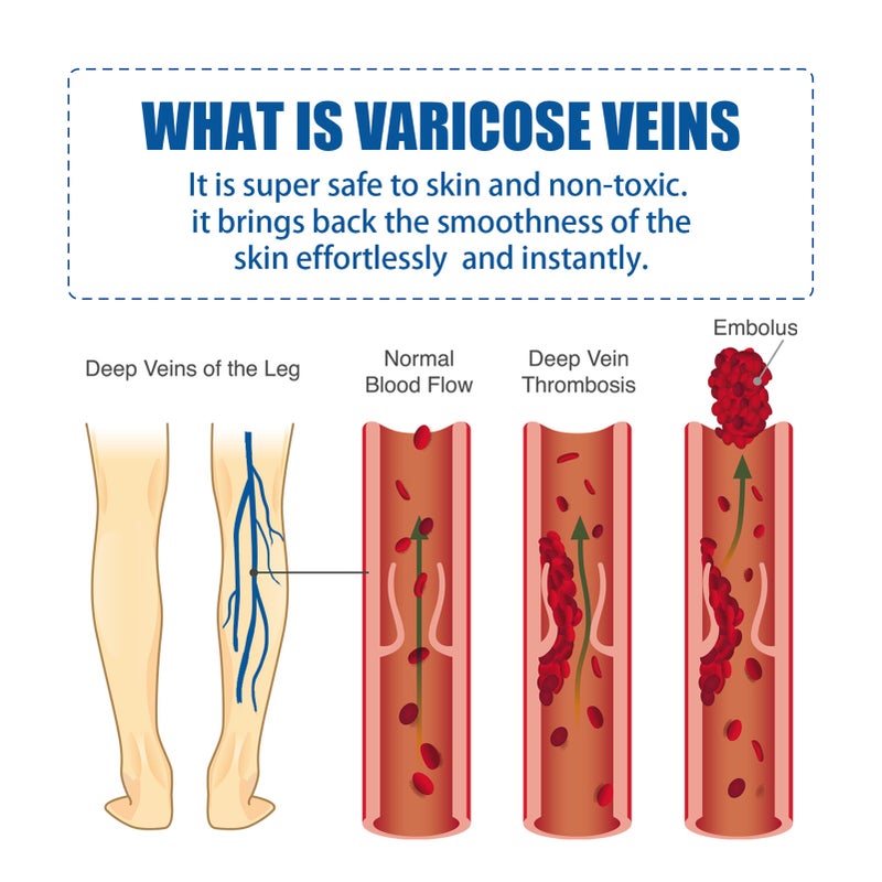 West&Month 25g Varicose Veins Therapy Cream + Rod Massage Absorption Relieve Symptoms Recurrence - Image 5