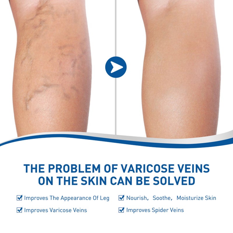 West&Month 25g Varicose Veins Therapy Cream + Rod Massage Absorption Relieve Symptoms Recurrence - Image 4
