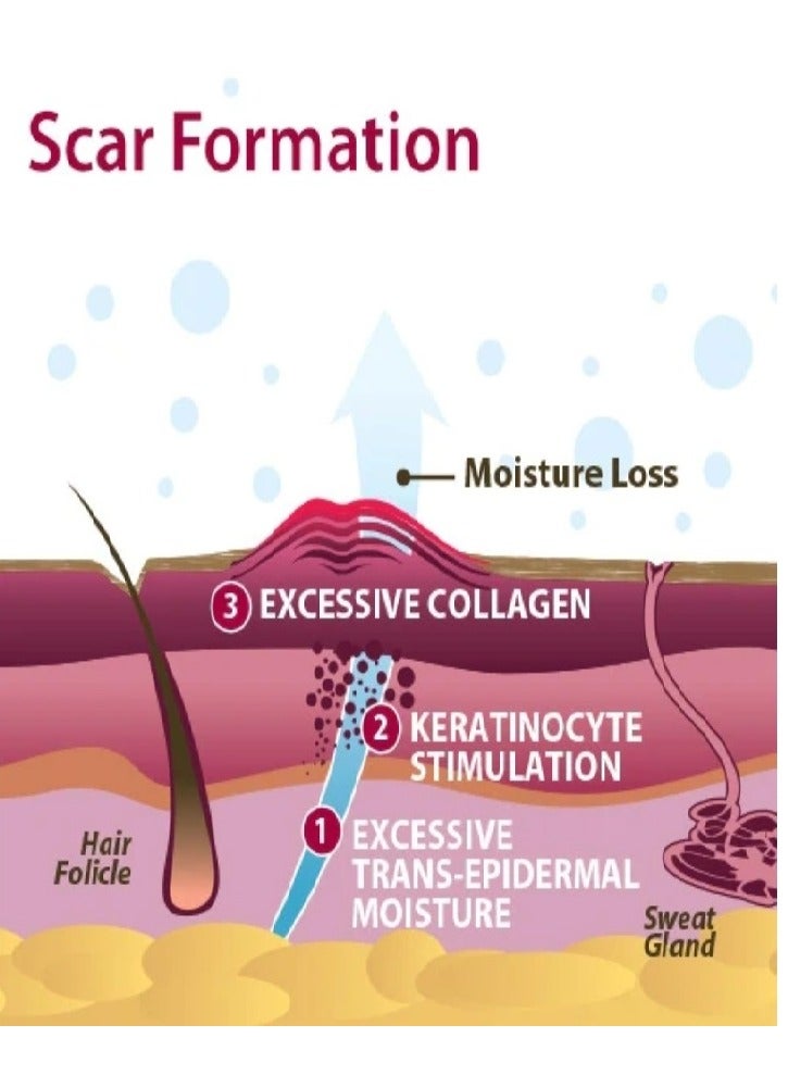 PROSIL Pro-Sil biodermis Patented Silicone Scar - Image 2