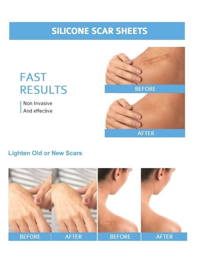 Hodaf Silicone Scar Sheets Stretch Mark Treatment Waterproof Silicone Gel Tape - Image 5
