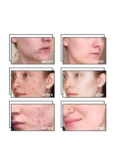 AuQuest Acne Remoyal Gure Gel -Herbal Acne Treatment Cream Pimple Spot Removal for Teens Oil Control Acne Scar Gel Shrink Pores Skin Care Beauty Health 20g  - Image 5
