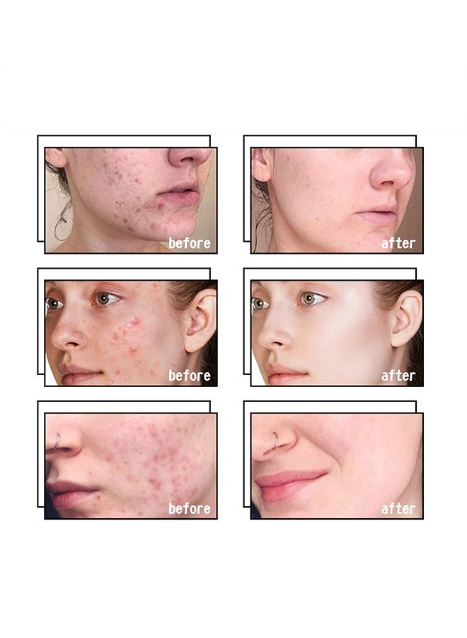 AuQuest Acne Remoyal Gure Gel -Herbal Acne Treatment Cream Pimple Spot Removal for Teens Oil Control Acne Scar Gel Shrink Pores Skin Care Beauty Health 20g - Image 5