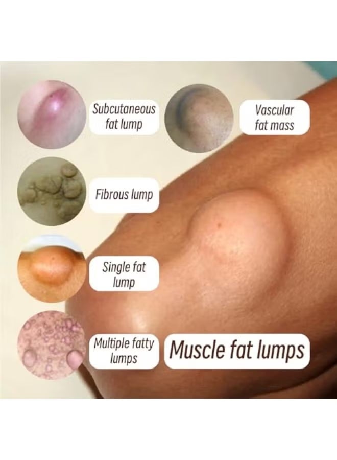 إيلهو Lipo Soothing Cream, Lipo Removal Cream, Instant Lipo Removal Cream, LumpFree Lipo Removal Cream, Herbal Lipo Removal Cream, Natural Vegetable Cream for Removing Lipo Clumps, 20 g - Image 2