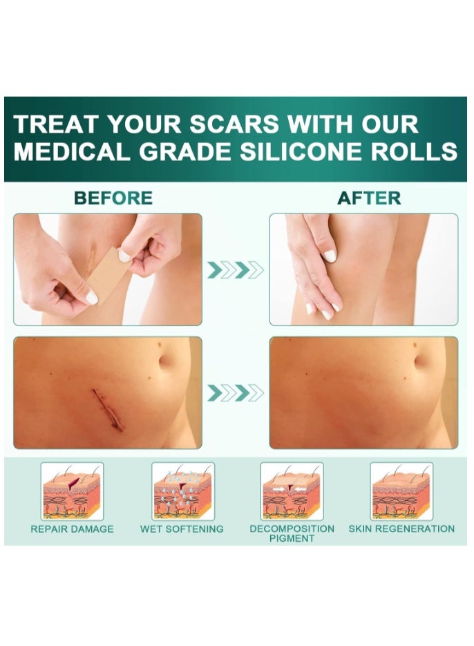 CICA Silicone Scar Sheet Prevents And Treats Scars 4cm X 150cm - Image 4
