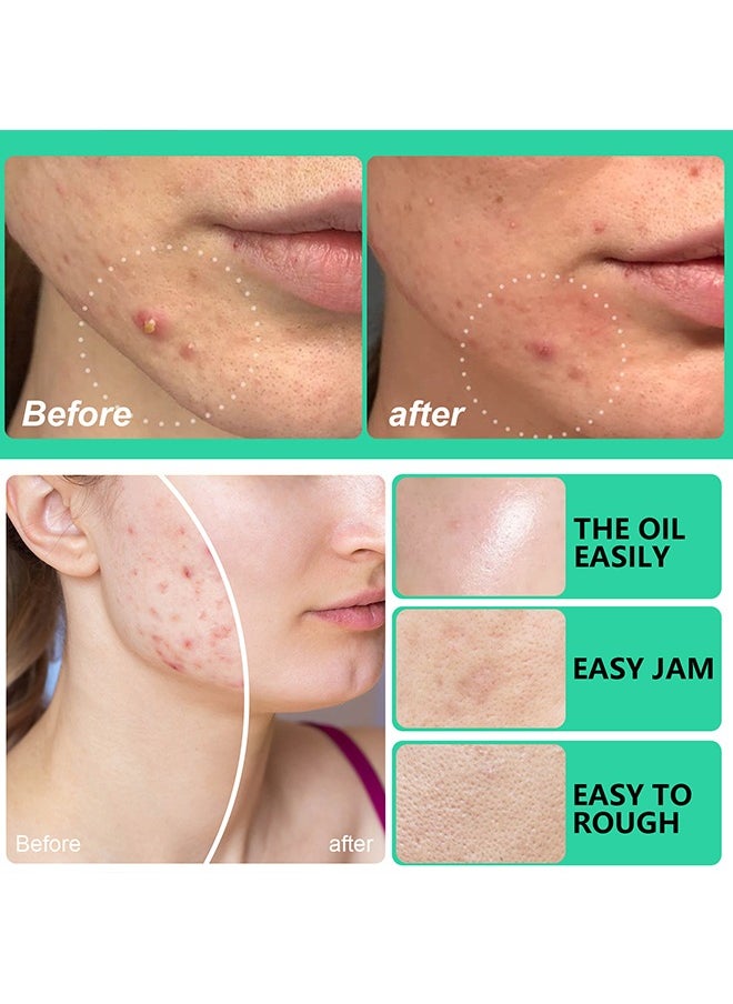 Elaimei - 10 Facial Acne Patches - Hydrocolloid Acne Patches to Cover Pimples and Blemishes - Acne Patches for Skin Care - Image 1