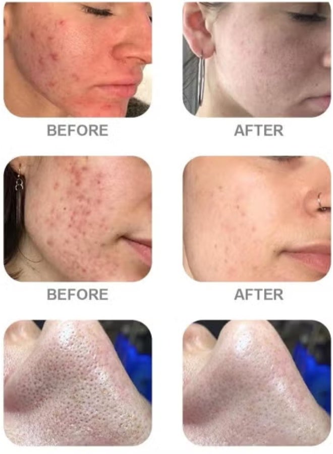 AS1 SA2 AO3 Water Light Exfoliating Liquid Blackhead Cleansing Advanced Salon Professional Microdermabrasion Essence, Suitable for Small Bubble Skin Care Mask Machine (AS1 SA2 AO3, 3*400ml) - Image 4