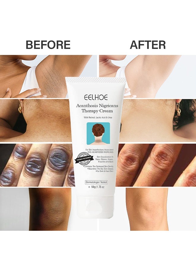 EELHOE Acanthosis Nigricans Therapy Cream, Skin Whitening Cream, Bleaching Cream, Brightening Cream, Skin Lightening Dark Spot Remover For Body Areas, Moisturizing And Hydrating Body Care For Underarm, Neck, Armpit, Knees, Elbows, 50G - Image 5