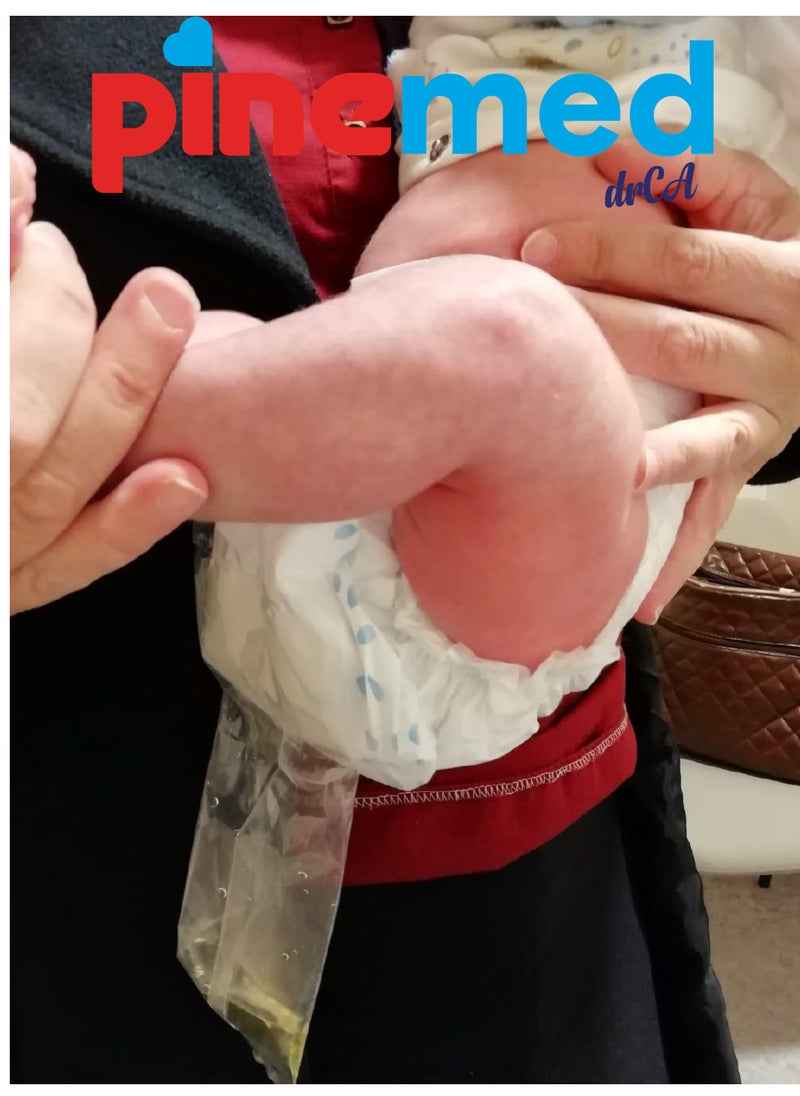 pinemed - Nappy Urine Collection | Baby Diaper with Sterile Pediatric Urine Collection Bag | PINEMED | Sample Collection Kit (0-5 kg) | Disposable for Infant, Newborn Baby | Urine Sample Collector - Image 1