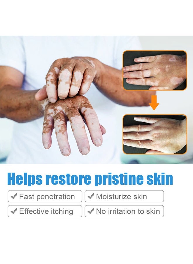 SOL LORA Vitiligo Removal Cream, Vitiligo Care Cream for Skin Vitiligo, Psoriasis, Leukoplakia, Reduces White Spots, Improve Skin Pigmentation Regulating 20g  - Image 4