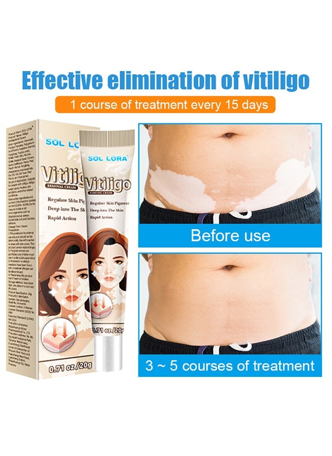 SOL LORA Vitiligo Removal Cream, Vitiligo Care Cream for Skin Vitiligo, Psoriasis, Leukoplakia, Reduces White Spots, Improve Skin Pigmentation Regulating 20g  - Image 5