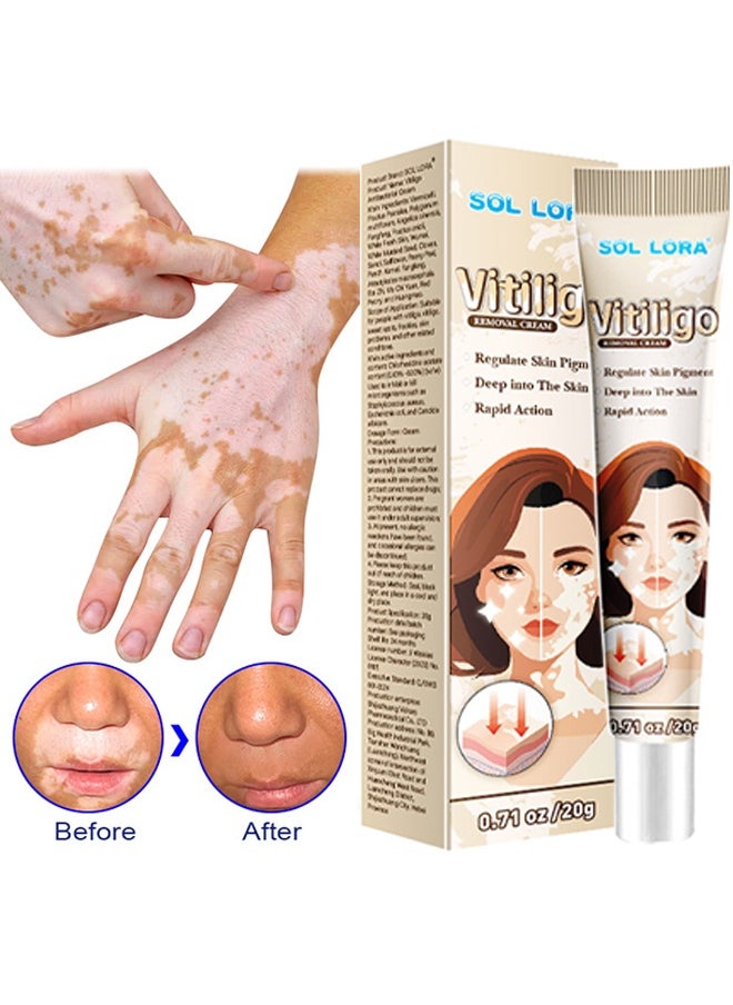 SOL LORA Vitiligo Removal Cream, Vitiligo Care Cream for Skin Vitiligo, Psoriasis, Leukoplakia, Reduces White Spots, Improve Skin Pigmentation Regulating 20g  - Image 3