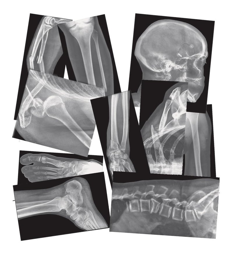 Roylco Broken Bones X-Ray Set, Projector Display Compatible, 15 X-Rays - Image 1
