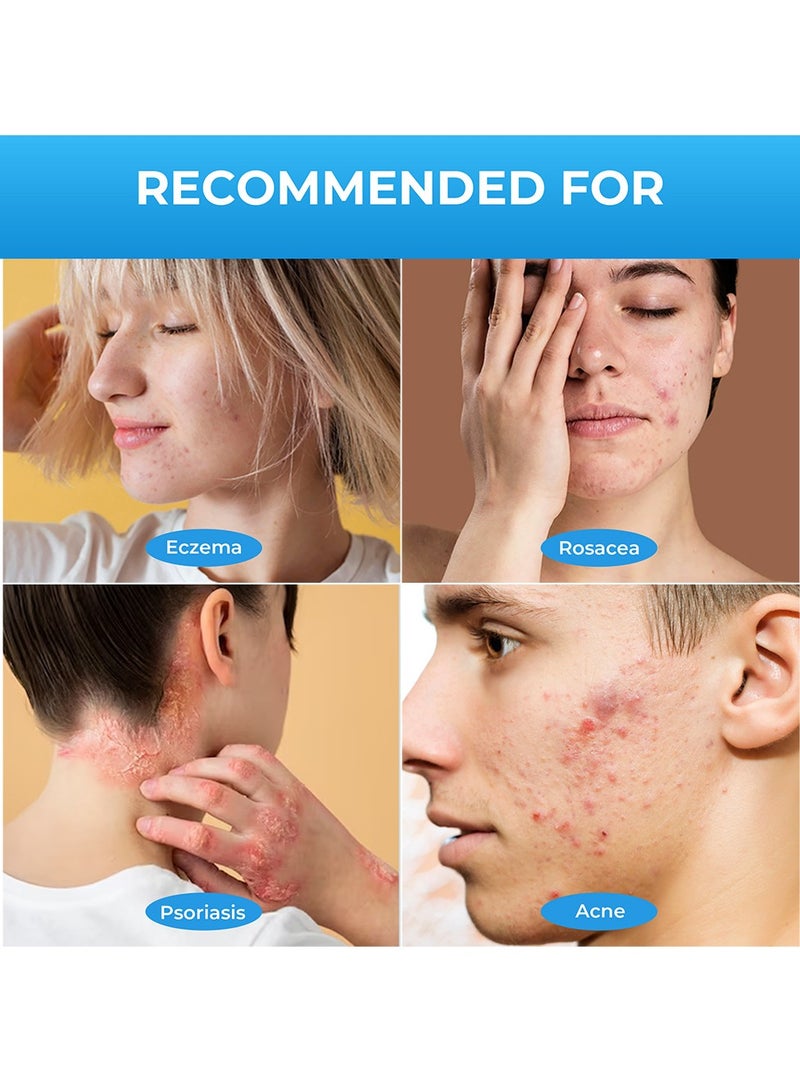 سوميفون مرهم سوميفون كالامين لعلاج الصدفية، 20 جرام - كريم لتخفيف الصدفية، علاج فعال للبشرة الجافة والحكة، مرهم مهدئ للأكزيما والتهاب الجلد، يدعم إصلاح الجلد لفروة الرأس واليدين والقدمين. - Image 3