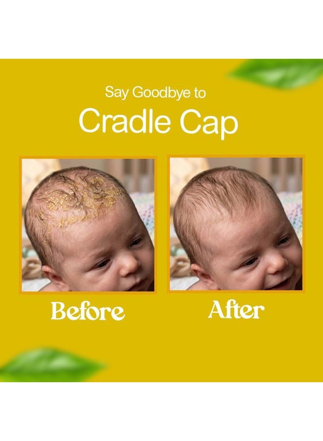 Bella B Bee Gone Cradle Cap Baby Shampoo (2-Pack), Treatment for Cradle Cap and Dry Scalp - Image 4