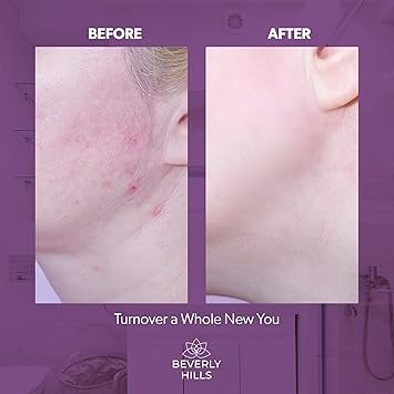 Beverly Hills 75 Glycolic Acid Peel with Lactic Acid Pyruvic Acid Face Exfoliator of Damaged Dead Skin Anti Aging Chemical Exfoliant for Face for Fine Lines Wrinkles Made in USA 50mL by Beverly Hills - Image 4