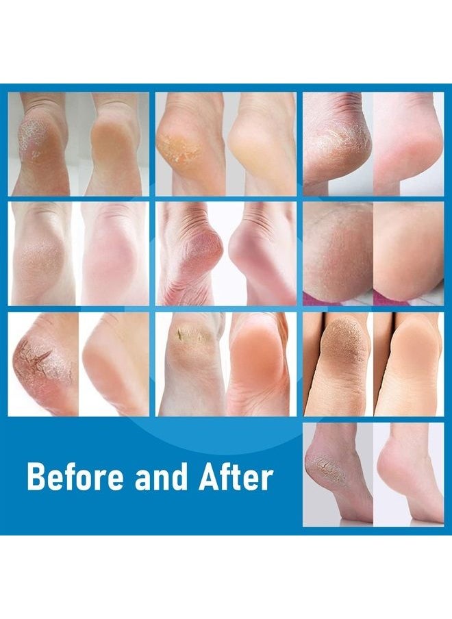 Xifepfr - XIFEPFR Callus Remover, Foot Scrubber Dead Skin Remover, Exfoliating Foot Spray, Spa Pedicure Treatment with Foot File, Cracked Heel Repair Cream, Silicone Heel Protector - Image 1