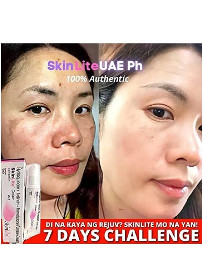 SKINLITE Skinlite Hydroquinone Tretinoin Mometasone Furoate Cream  - Image 2