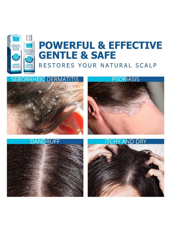 Roycederm - Oycederm Psoriasis Shampoo Seborrheic Dermatitis Shampoo Folliculitis Shampoo Dandruff Shampoo Scalp Psoriasis Treatment Seborrheic Dermatitis Treatment Dry Itchy Scalp Treatment - Image 1