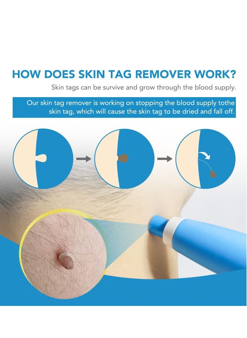 Sefudun Wart Removal Tool Skin Tag Removal Double Head Blue， Skin Tag Removal Tool Kit，2mm to 8mm Auto Wart Remover，Safe & Painless & Easy Remover Clear Skin Tag & Mole at Home  - Image 2