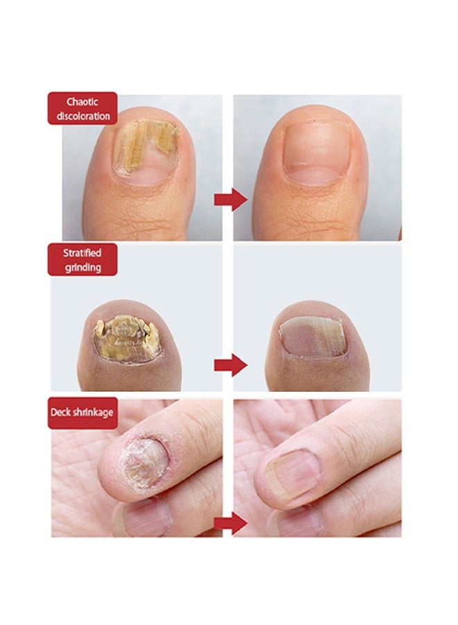 DERMFREE Nail Toenail Cream，Nail Repair Cream, 20g Nail Cream Anti Harmful Substance Repair Finger Toe Nail Care Perfect for Men and Women Home Use - Image 4