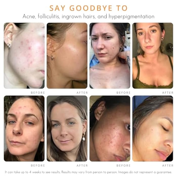 Almond Clear Face & Body Clearing Serum, Level 1- for acne, folliculitis, aging skin, ingrown hairs, dark spots - face, chest, butt, back, thighs, arms - mandelic acid - 1 fl oz - Image 5