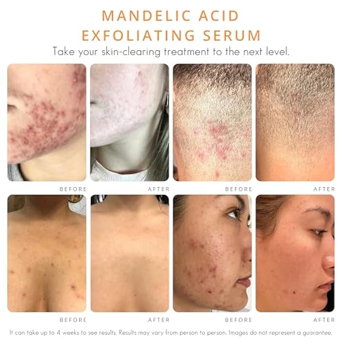 Almond Clear Face & Body Clearing Serum, Level 1- for acne, folliculitis, aging skin, ingrown hairs, dark spots - face, chest, butt, back, thighs, arms - mandelic acid - 1 fl oz - Image 3