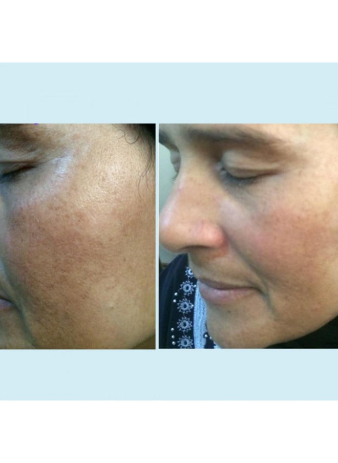 Lactic 50% Gel Peel, Chemical Peels for Face Breakout Scars, Chemical Exfoliant for Face, Strength Level 2, 1.0 fl oz. e, 30 mL Perfect Image