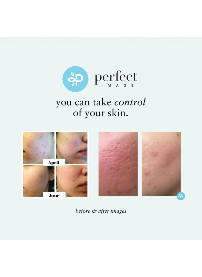 Lactic 50% Gel Peel, Chemical Peels for Face Breakout Scars, Chemical Exfoliant for Face, Strength Level 2, 1.0 fl oz. e, 30 mL Perfect Image