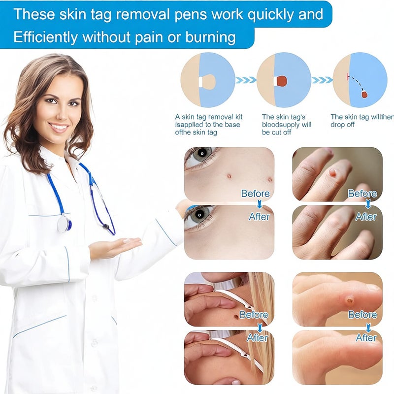 Remove Skin Tag Pen Facial Care Nevus Tool 1mm-8mm Remove Meat Nevus Corns Warts Skin Tag Removal Tool Replaceable Head - Image 3