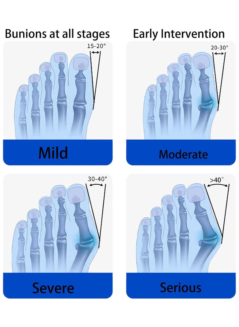 Bunion Corrector for Women Men Big Toe Adjustable Knob Bunion Corrector for Bunion Relief Bunion Fix with Bunion Silicone Pad Suitable for Left and Right Feet - Image 5