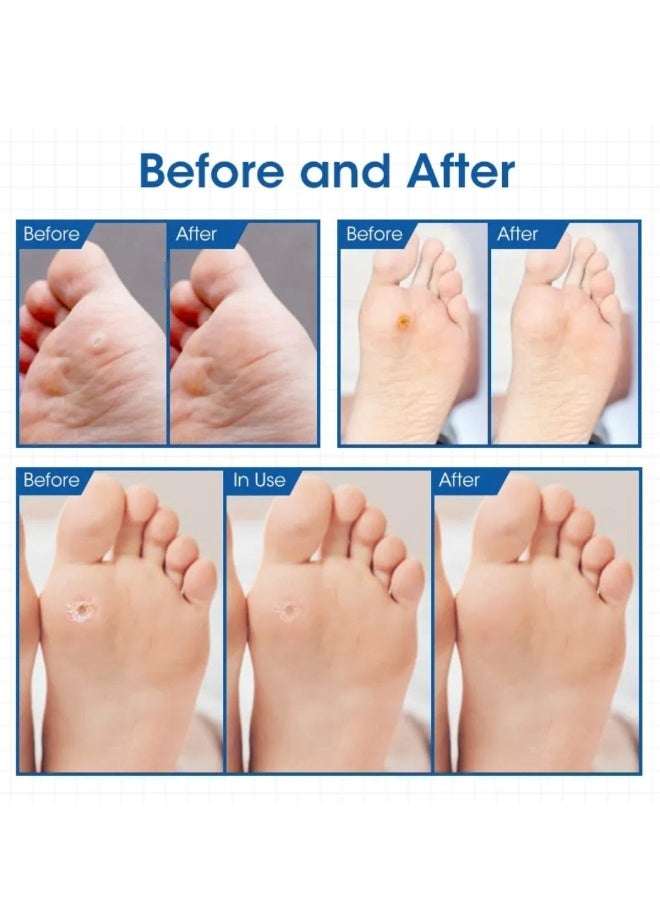 MQ 24 Pcs Corn Remover Pads Foot Corn Remover Patch Wart Remover Corn Removal Ideal for Relief Corn Pain and Foot Care Corn Plasters with Hole for Feet Hand Toe Corn Removal Pads - Image 3