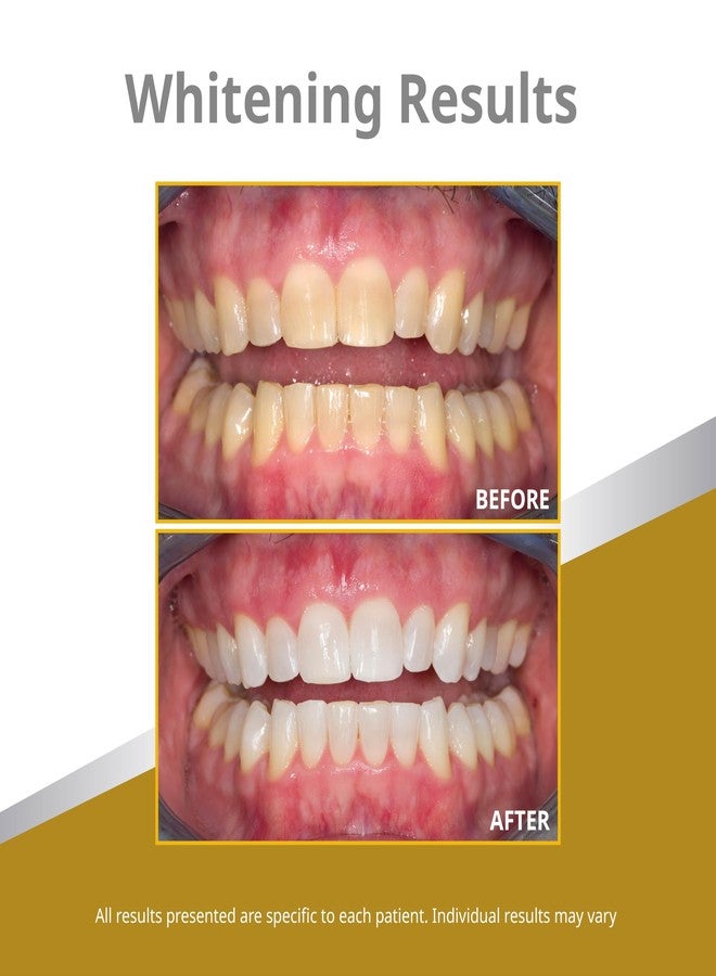 Opalescence 45% Syringes Teeth Whitening Gel - with PF - (4 Syringes) Refill Kit Carbamide Peroxide. Made by Ultradent, in Mint Flavor. Tooth Whitening 5359-2 - Image 4