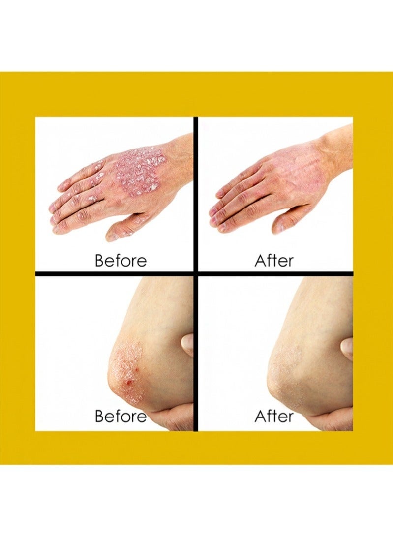 Sumifun Psoriasis Cream for Itching Relief | Eczema & Dermatitis Skin Care Cream | Antibacterial Herbal Soothing Cream | Anti-Itch Skin Repair Treatment | Daily Skin Comfort Care | 20g - Image 4