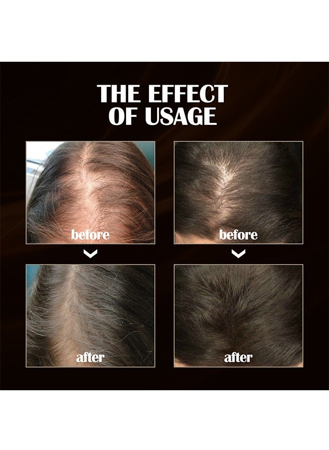 OUHOE - Hair Regrowth Treatment Spray,Ginger Hair Thickening Spray Anti-Hair Loss Firming Nourishing Strong and Thick Hair, Treatment Hair Growth Essence, Dense Hair Regeneration Spray, Suitable for Men and Women(20ml/0.7fl.oz) - Image 1