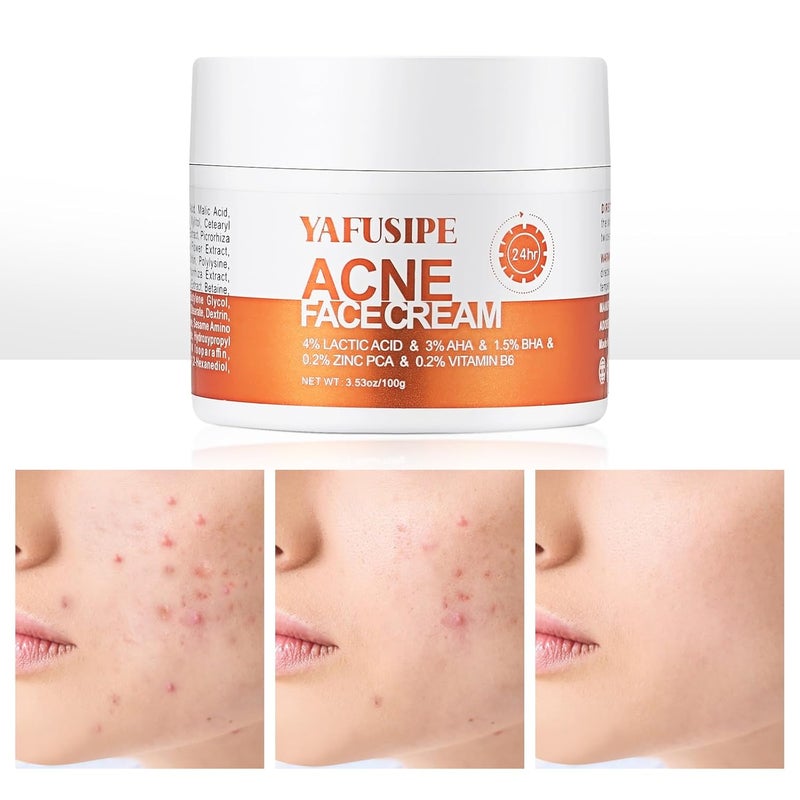 YAFUSIPE Acne Treatment for Face for Hormonal Cystic Stubborn Acne Cream for Sensitive Skin Teens Adults Women Men Spot Pimple Butt Control Rapid Clearing Breakout Overnight 