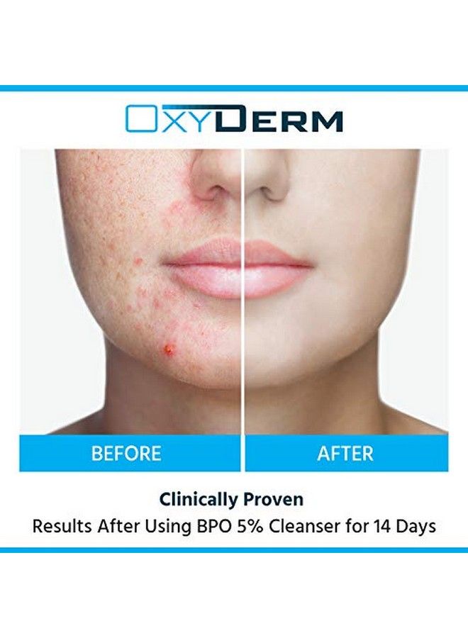 OxyDerm منظف حب الشباب بيروكسيد البنزويل 5% غسول مثبت سريريًا لمحاربة عيوب حب الشباب عند ملامسته للبشرة. يزيل البثور الكيسية والبشرة الدهنية والمسام المسدودة والرؤوس السوداء والرؤوس البيضاء للوجه والجسم. - Image 3