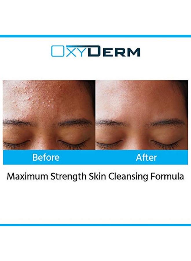 OxyDerm منظف حب الشباب بيروكسيد البنزويل 5% غسول مثبت سريريًا لمحاربة عيوب حب الشباب عند ملامسته للبشرة. يزيل البثور الكيسية والبشرة الدهنية والمسام المسدودة والرؤوس السوداء والرؤوس البيضاء للوجه والجسم. - Image 5