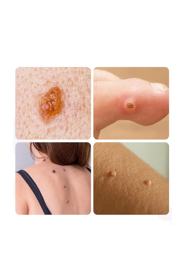 SAUVASINE Sowasink's Warts Liquid, Warts Liquid, Black Moles, Plantar Warts, Acute Warts, Filamentous Warts - Image 4